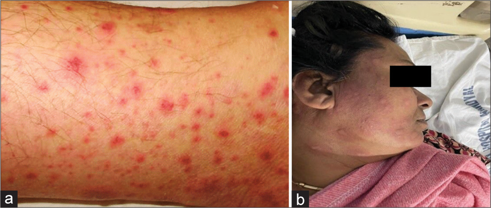 (a) Close view of rash (b) Rifampicin induced rash.