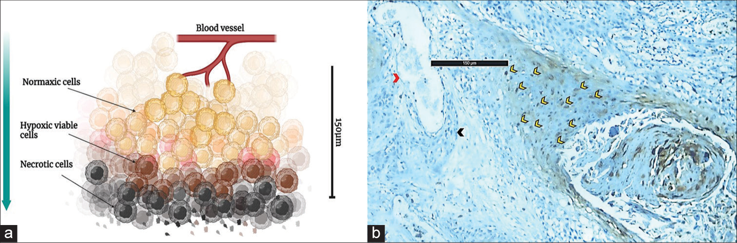 (a) Image showing tumor hypoxia in relation to distance from blood vessel (Figure made with BioRender online software), (b) photomicrograph showing positive expression of hypoxia inducible factor (HIF)-1α in tumor cells ~150 µm away from blood vessel (DAB, ×10 objective lens; Red arrow head: Blood vessel; Black arrow head: Tumor cells with no expression for HIF-1α; Yellow arrow heads: Nuclear expression of HIF. DAB: Diaminobenzidine.