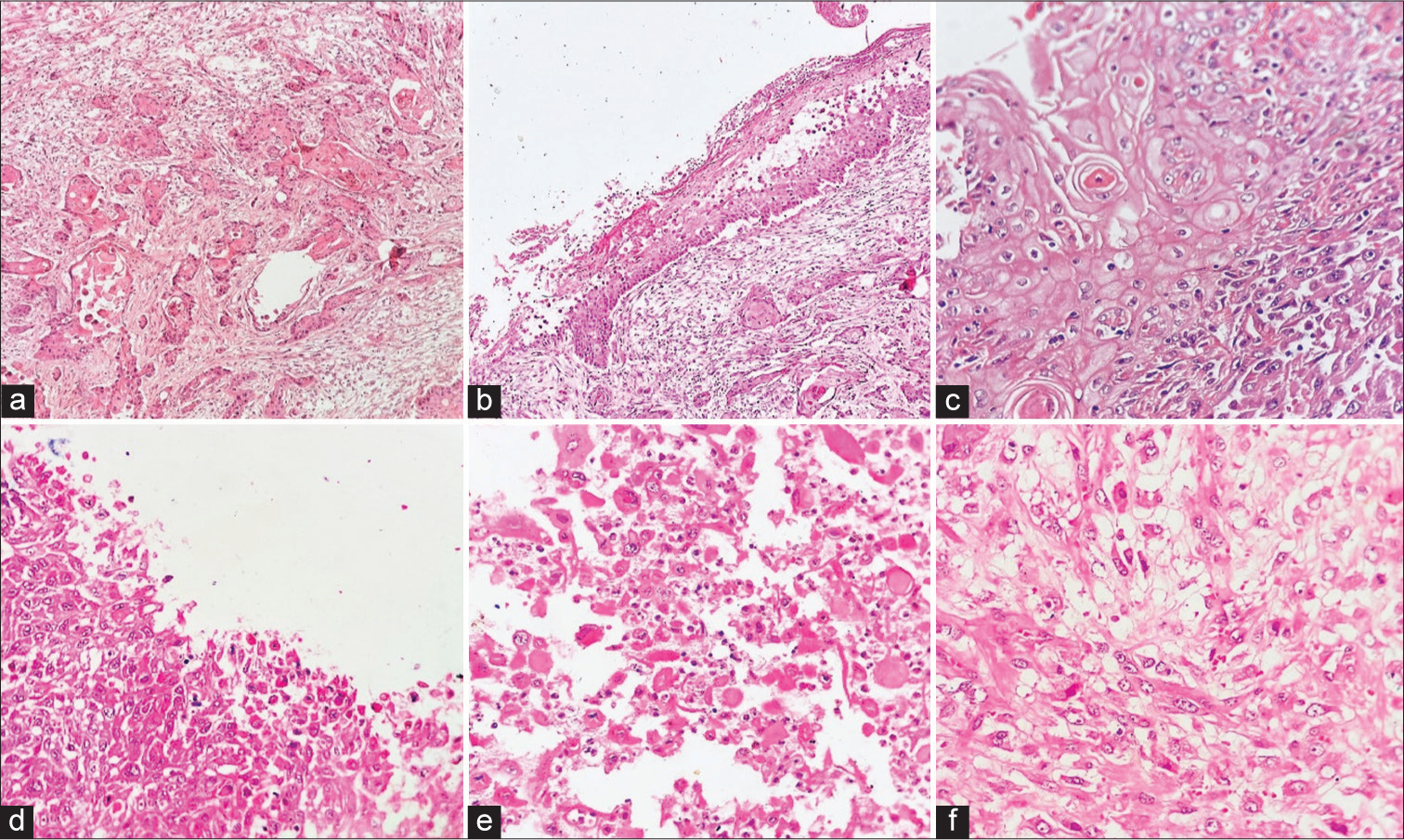 (a) Malignant tumor showing nests of squamoid cells, displaying an infiltrative growth pattern. Tumor nests and islands showing intercellular bridges and keratin pearl formation (HE ×40), (b and c) individual cells showing hyperchromasia, irregular nuclear membrane, and dense eosinophilic cytoplasm (HE ×40, ×100), and (d-f) malignant squamous cells appeared round to oval (acantholytic cells) and dyscohesive in nature, scattered throughout the tumor substance (HE ×100, ×200, ×400). HE: hematoxylin and eosin.