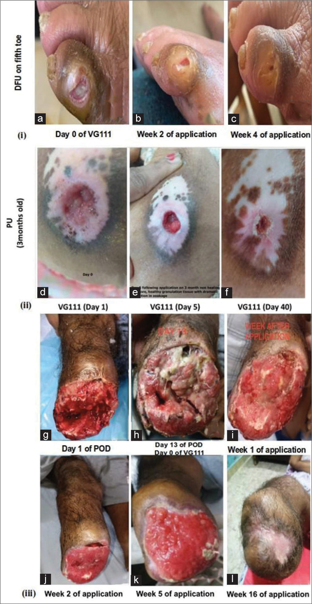 Ulcerated wound and amputated tissue application of VG111 in humans. (i, a-c) Diabetic foot ulcer on fifth toe in 65-year-male, VG111 application was applied on 18th day following povidone-iodine based dressing; (ii, d-f) pressure ulcer on the back of 95-year female and; (iii, g-l) below-knee amputation of a 48-year diabetic male, no antibiotics or graft was required. DFU: Diabetic foot ulcers, PU: Pressure ulcers.