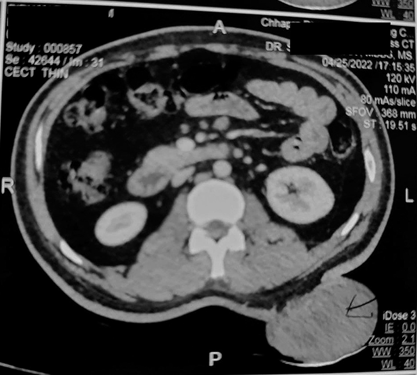 Contrast-enhanced computed tomography (CECT) scan showed a mass at D12-L3 level, involving the overlying skin but sparing the underlying muscle and abdominal wall.