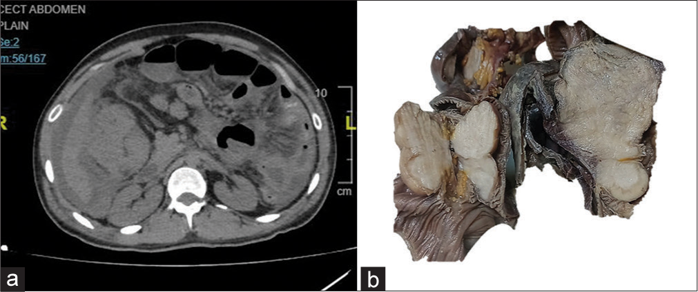 (a) Contrast-enhanced computed tomography shows multiple exophytic masses in the serosal aspect of the intestine, causing luminal narrowing. (b) A gross image of multiple submucosal solid masses in the small intestine.