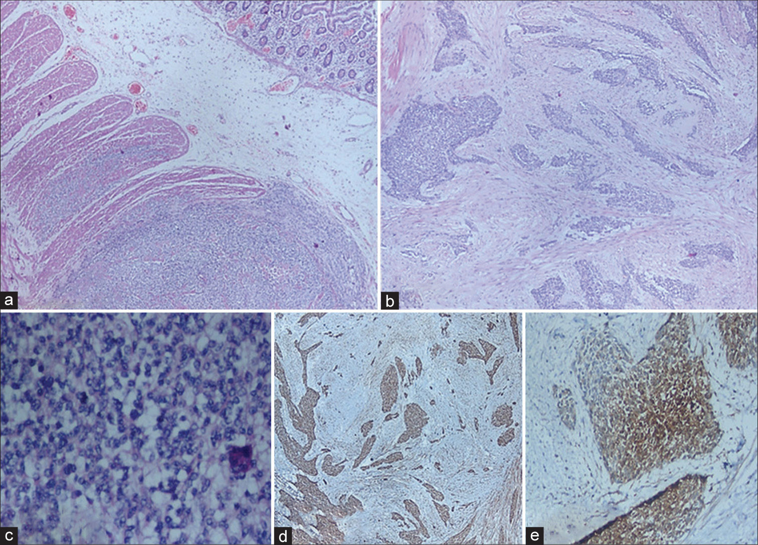 (a) Submucosal tumor infiltrating muscularis propria with adjacent normal intestinal mucosa, ×100 H&E; (b) nests and cords of tumor cells with desmoplastic stroma, ×200, H&E; (c) sheets of small round cells with hyperchromatic nuclei with scant cytoplasm, ×400, H&E; and (d) desmin immunostain shows cytoplasmic positivity ×400, diaminobenzidine (DAB); (e) Neuron-specific enolase immunostain shows cytoplasmic positivity ×400, DAB. H&E: Hematoxylin and Eosin, DAB: Diaminobenzidine