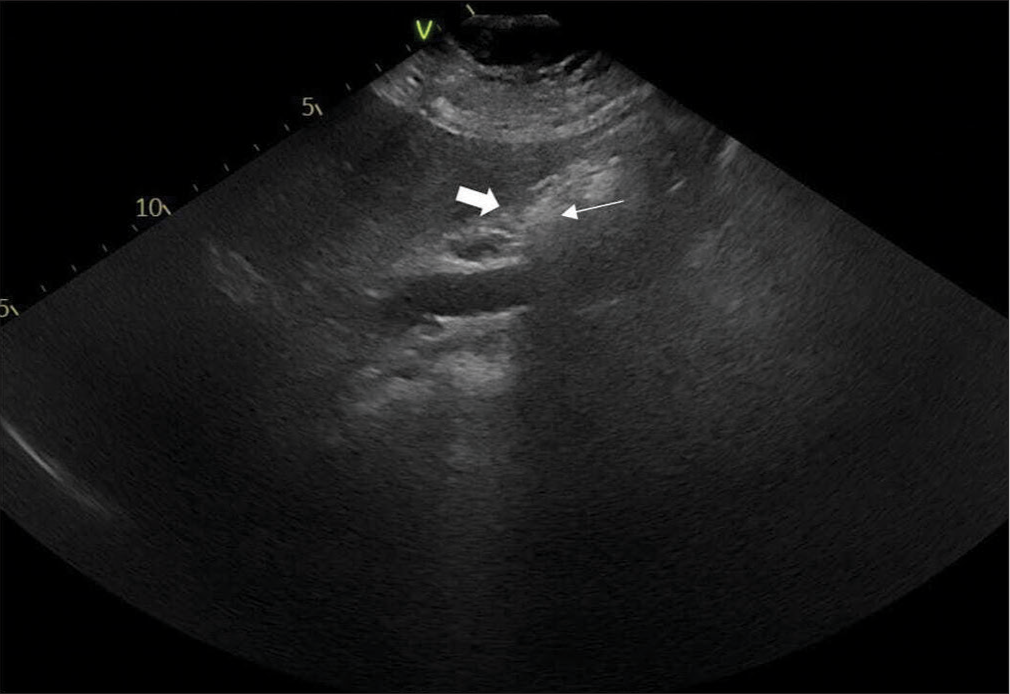 A sonographic image of the patient shows a contracted gallbladder (thick white arrow) with a thickened wall with calculi (thin white arrow) seen with the gallbladder having posterior acoustic shadows.