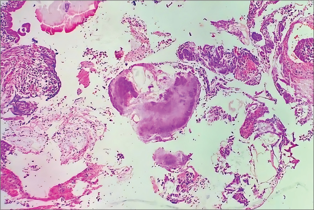 Histopathological examination of the gallbladder revealed features of chronic cholecystitis along with spherical colonies of actinomycosis composed of radiating filaments (Hematoxylin and Eosin (HE) ×40).