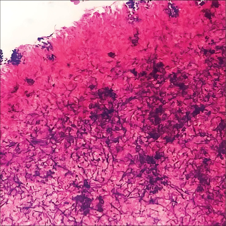 Gram stain (×40) highlights aggregates of actinomyces bacilli.