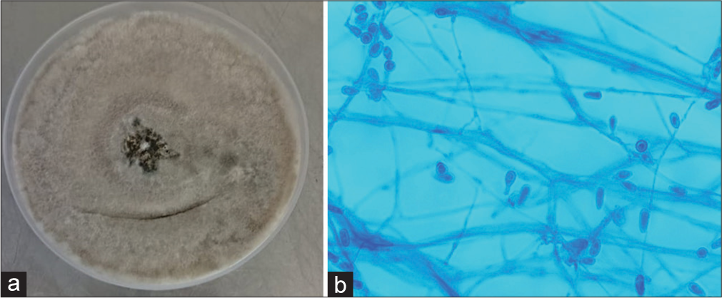 (a) Culture of Scedosporium apiospermum on Sabouraud dextrose agar. (b) Lactophenol cotton blue mount of S. apiospermum ×400 magnification.