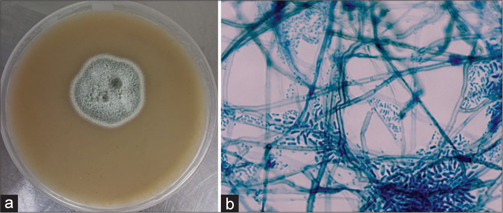 (a) Culture of Phaeoacremonium parasiticum on Sabouraud dextrose agar. (b) Lactophenol cotton blue mount of P. parasiticum ×400 magnification.