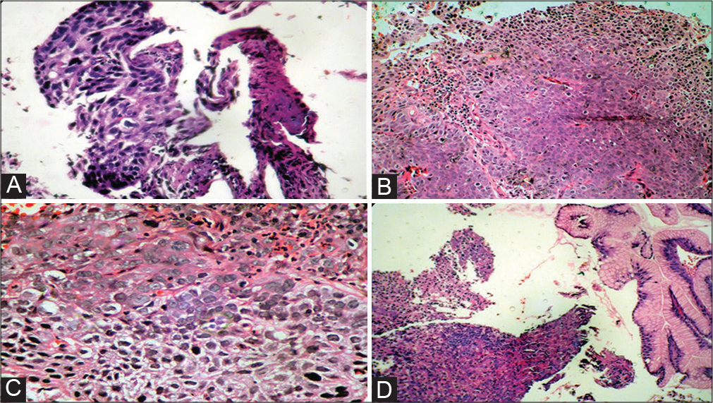 (A) Hematoxylin and eosin (H&E) photomicrograph of poorly differentiated squamous cell carcinoma (SCC) of lung (40 × ). (B) H&E photomicrograph exhibiting moderately differentiated SCC of lungs. (C) H&E stained photomicrograph exhibiting poorly differentiated SCC of esophagus. (D) H&E photomicrograph of gastric adenocarcinoma.