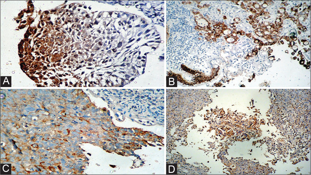 (A) Photomicrograph of poorly differentiated squamous cell carcinoma (SCC) of esophagus showing cytoplasmic positivity for cyclooxygenase-2 (COX-2). (B) Photomicrograph of gastric adenocarcinoma exhibiting cytoplasmic positivity for COX. (C) Photomicrograph of poorly differentiated SCC of lung exhibiting cytoplasmic positivity for COX-2. (D) Photomicrograph of poorly differentiated SCC of esophagus showing cytoplasmic positivity for COX-2.