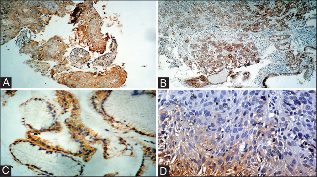 (A) Photomicrograph of gastric adenocarcinoma exhibiting cytoplasmic positivity for vascular endothelial growth factor (VEGF). (B) Photomicrograph of moderately differentiated squamous cell carcinoma (SCC) of lung showing cytoplasmic staining for VEGF. (C) Photomi- crograph of gastric adenocarcinoma showing cytoplasmic positivity for VEGF (40 × ). (D) Photomicrograph of poorly differentiated SCC showing cytoplasmic positivity for nitric oxide synthase-2 (NOS-2).