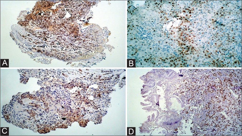 (A) Photomicrograph of small cell lung carcinoma exhibiting nuclear positivity for p53. (B) Photomicrograph of moderately differentiated squamous cell carcinoma (SCC) of esophagus exhibiting nuclear positivity for p53. (C) Photomicrograph of gastric adenocarcinoma exhibiting nuclear positivity for p53. (D) Photomicrograph of moderately differentiated SCC of lung exhibiting nuclear positivity for p53.
