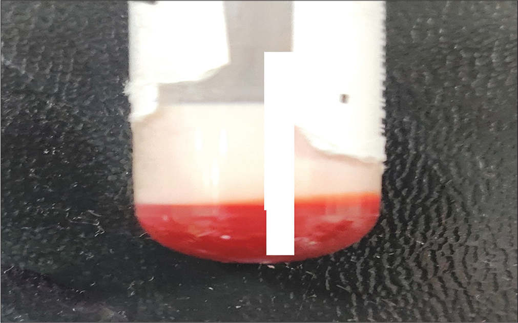 The lactescent plasma appearance of the vacutainer blood sample after slow centrifugation.