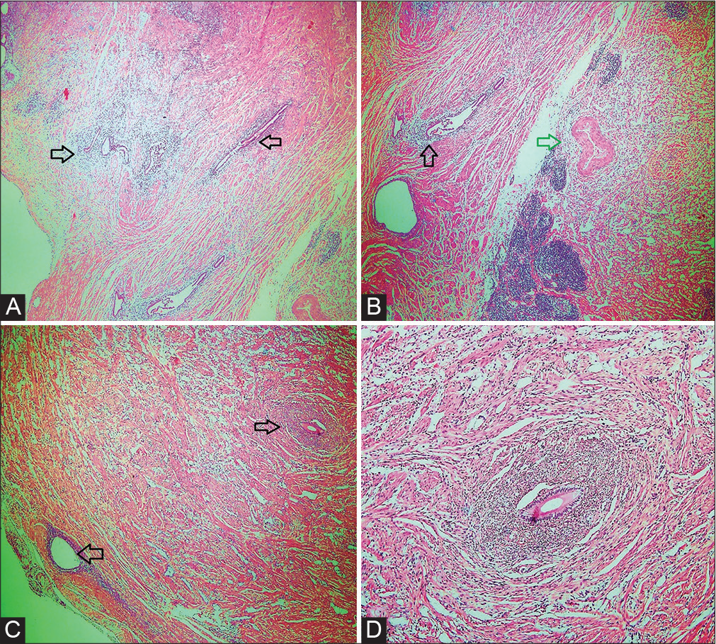 (A) Surrounding tubal wall and part of ovary showing focal presence of endometriosis (arrows). (B) Low power view showing presence of endometriosis in the tubal wall (black arrow) and part of adenomatoid tumor (green arrow) (hematoxylin and eosin [HE] 40 ×). (C) Glandular spaces surrounded by thin cuff of endometrial stromal cells in the tubal tumor, suggestive of intratumoral endometriosis (HE 40 ×). (D) A glandular space lined by bland ciliated columnar epithelium, surrounded by thin cuff of endometrial stromal cells (HE 200 ×).