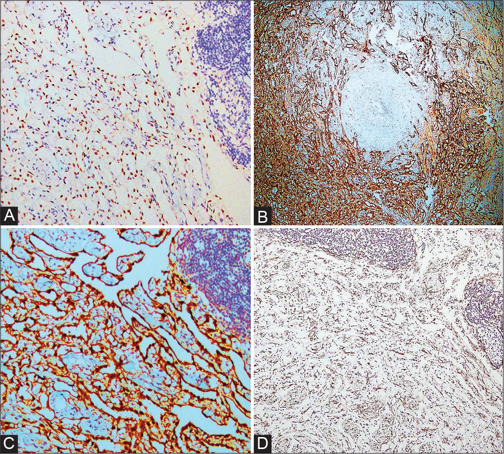 Immunohistochemical stain. (A) Wilms tumor 1 (WT1): Nuclear positivity in the tumor cells (200 × ). (B) Calretinin: Positive in the tumor cells of adenomatoid tumor (endometriotic foci: negative). (C) Calretinin: Nuclear positivity in tumor cells (200 ×). (D) CD34 positivity highlighting the rich capillary network traversing in between the cellular component of tumor (40 ×).