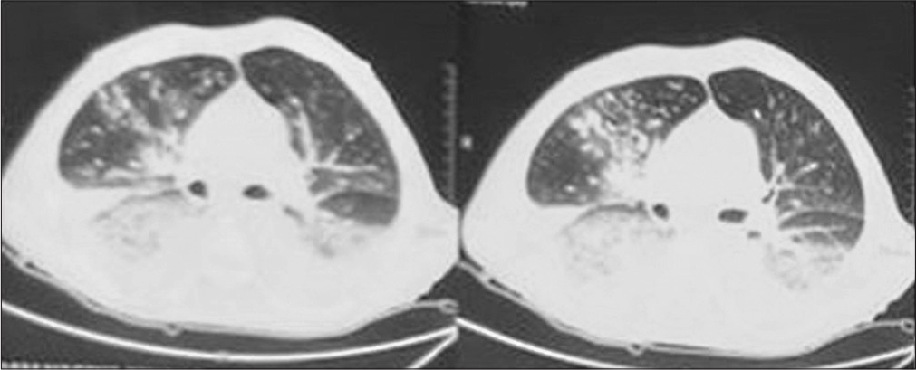 High-resolution chest tomography of case 1 showing nodular opacities suspected of fungal pneumonia.