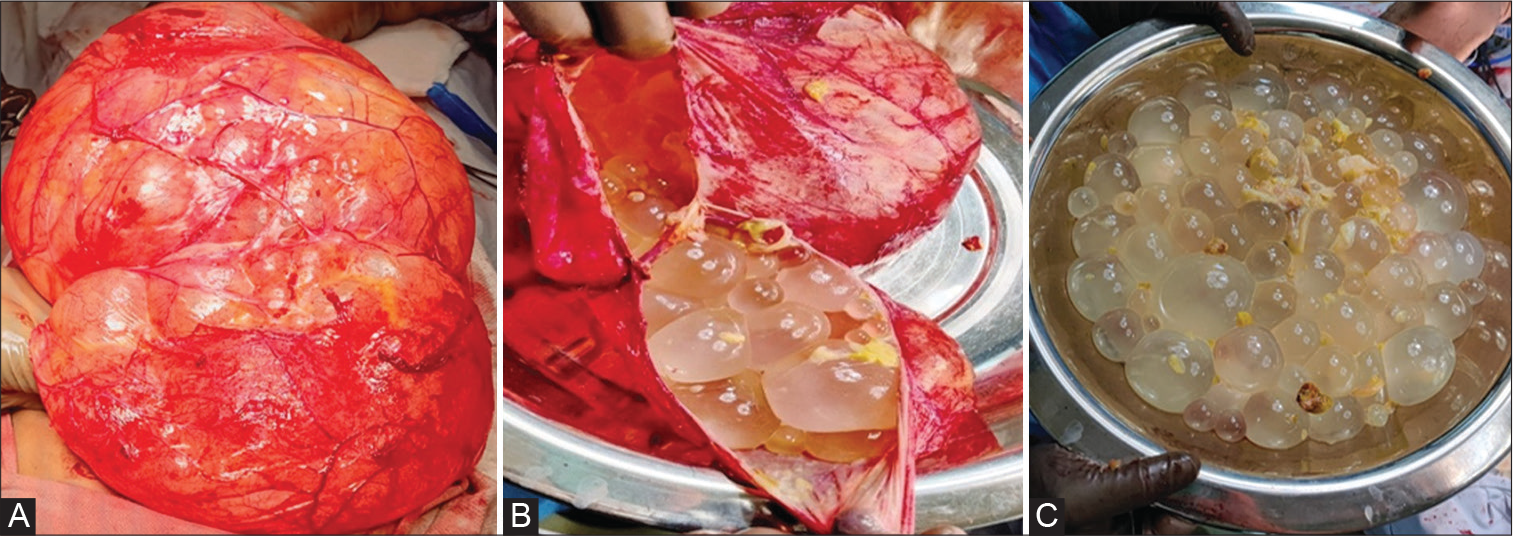 (A) Intraoperative picture of a large thin-walled cyst, (B) multiple daughter cyst inside the cyst, (C) daughter cyst delivered out.