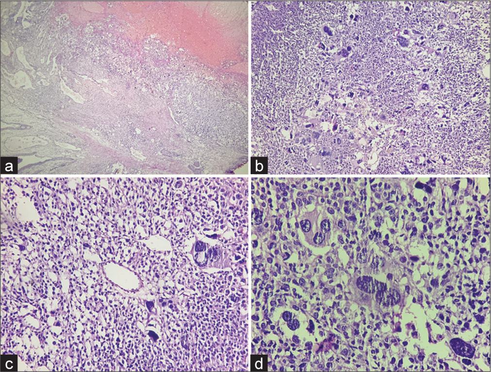 Histopathological findings (a) A low-power view shows nested architecture of the tumor at the right upper and the epithelium of prostatic urethra at the left lower corner (Hematoxylin and eosin, ×4). (b) Many bizarre multinucleated giant cells are seen (Hematoxylin and eosin, ×10). (c and d) Photomicrograph showing tumor cells surrounded by thin delicate vessel and are epithelioid with abundant clear-to-eosinophilic cytoplasm, round nuclei and prominent nucleoli (Hematoxylin and eosin, ×20 and ×40 respectively).