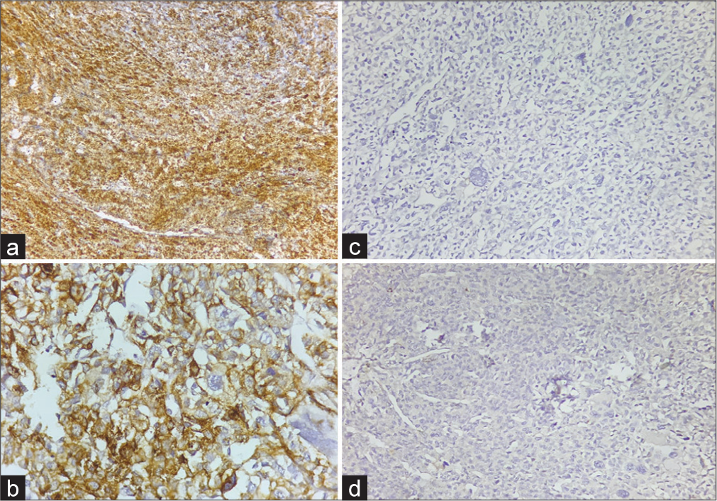 (a) Diffuse Human Melanoma Black 45 positive tumor cells (Diaminobenzidine, ×20). (b) Immunohistochemistry (IHC) showing absent staining for Anti-cytokeratin monoclonal antibodies (Diaminobenzidine, ×20). (c) Diffuse positivity for smooth muscle actin in tumor cells (Diaminobenzidine, ×40). (d) IHC showing absent staining for SRY (sex determining region Y) -Box transcription factor 10 (Diaminobenzidine, ×20).