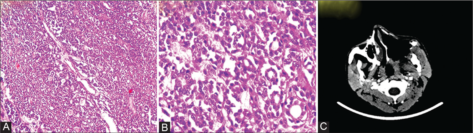 (A) Maxillary sinus tumor (hematoxylin and eosin [H&E] stain 40X). (B) Maxillary sinus tumor (H&E stain 400X). (C) Postoperative plain computed tomography of paranasal sinus.