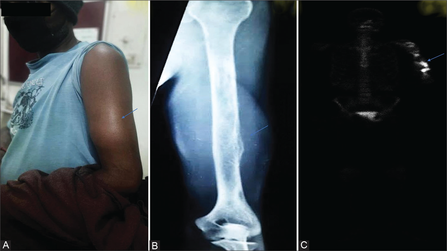 (A) Clinical photograph of the patient. (B) X-ray of the left arm. (C) Fluorodeoxyglucose positron emission tomography-computed tomography whole body imaging.