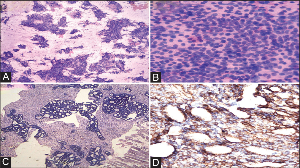 (A) Fine-needle aspiration cytology (FNAC) from left-arm swelling (May Grunwald-Giemsa stain 100X). (B) FNAC from left-arm swelling (MGG stain 400X). (C) Trucut biopsy left arm (hematoxylin and eosin stain 40X). (D) Immunohistochemistry: anti-c-kit antibody (40X).