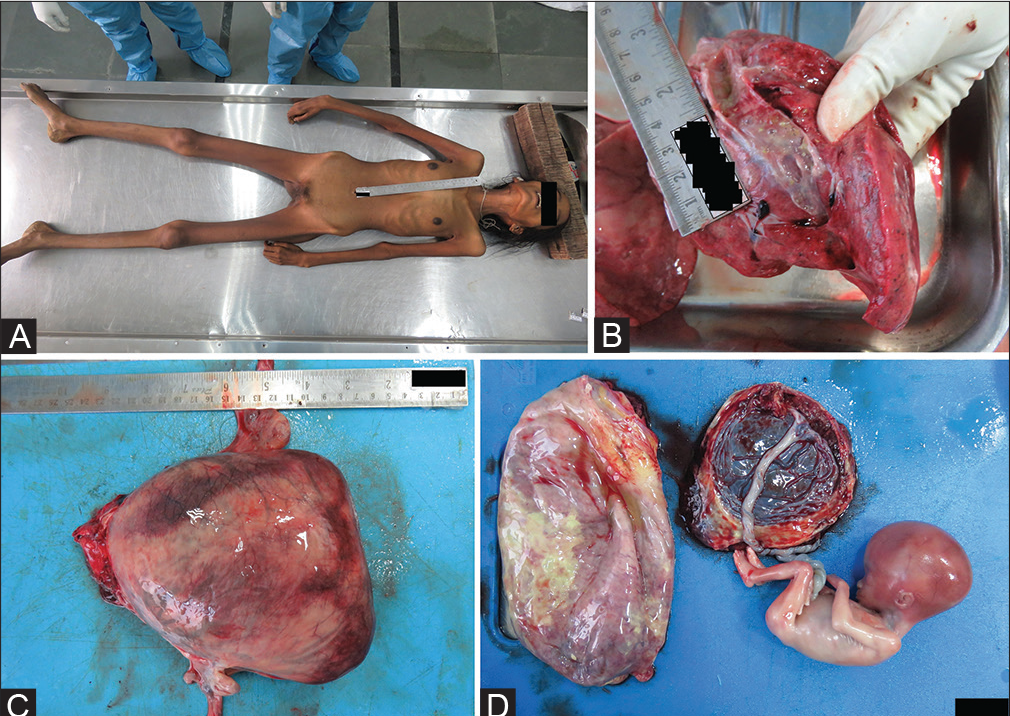 (A) Thin emaciated body. (B) Yellowish granular material as aspirate along with mucoid material in the bronchus and bronchioles. (C) Uterus dimensions: 21 (length) × 17 cm (width) × 4 cm (anteroposterior). (D) Fetus of length 19 cm with placenta.