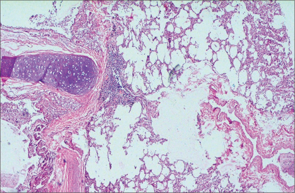 Inflammatory changes around the bronchial cartilage and interstitial inflammation. 40x Hematoxylin and eosin stain.