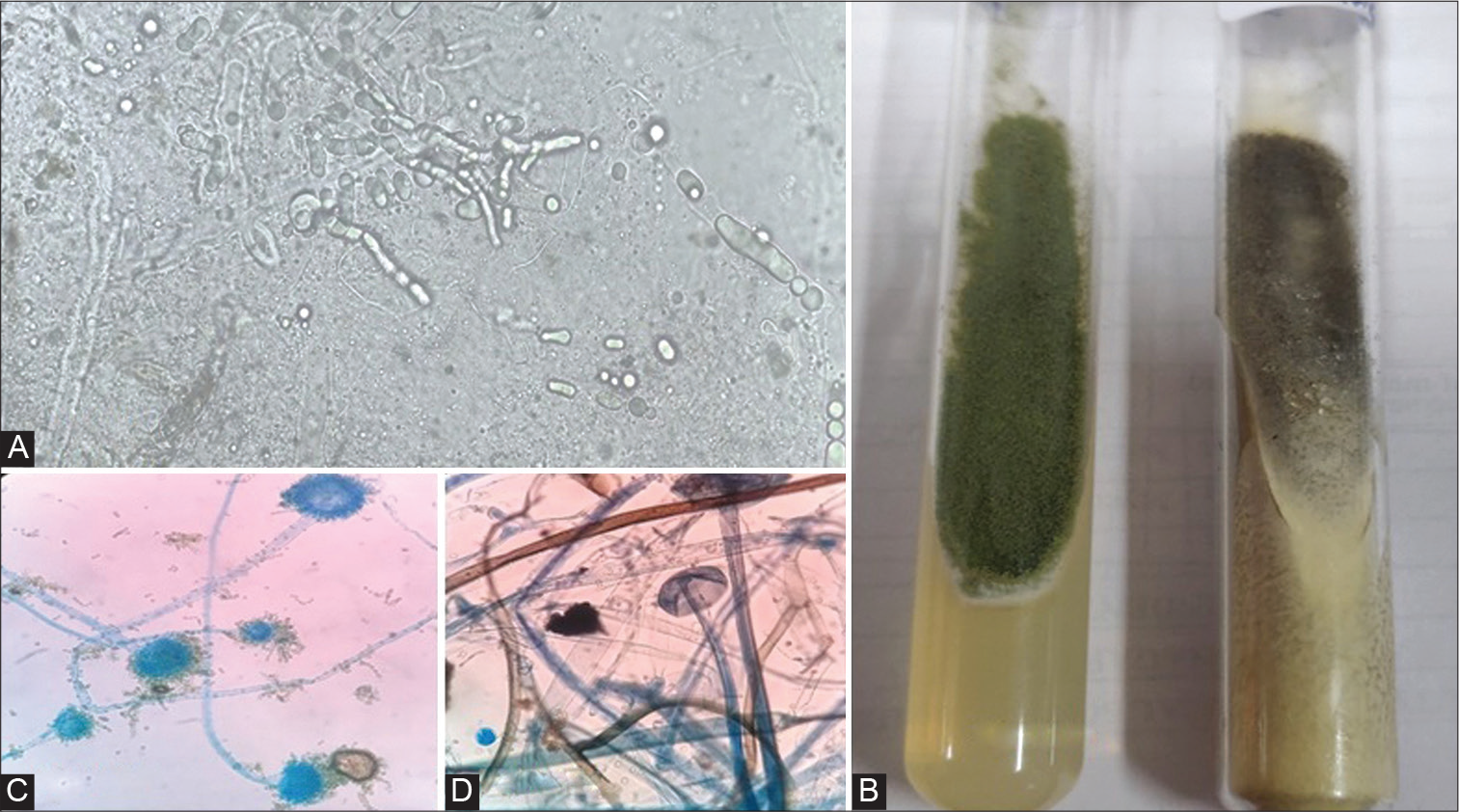 (A) Potassium hydroxide preparation displaying hyaline, septate acute angle branched hyphae of Aspergillus flavus and thin walled, broad, aseptate hyphae of Rhizopus arrhizus (40X). (B) Growth on Saboraud dextrose agar medium with chloramphenicol: left tube (Green) representing Aspergillus flavus and right tube (black) represents Rhizopus arrhizus. (C) Smears prepared from culture growth stained with lactophenol cotton blue revealed morphology of Aspergillus flavus (40X). (D) Smears prepared from culture growth stained with lactophenol cotton blue revealed morphology of Rhizopus arrhizus (40X).