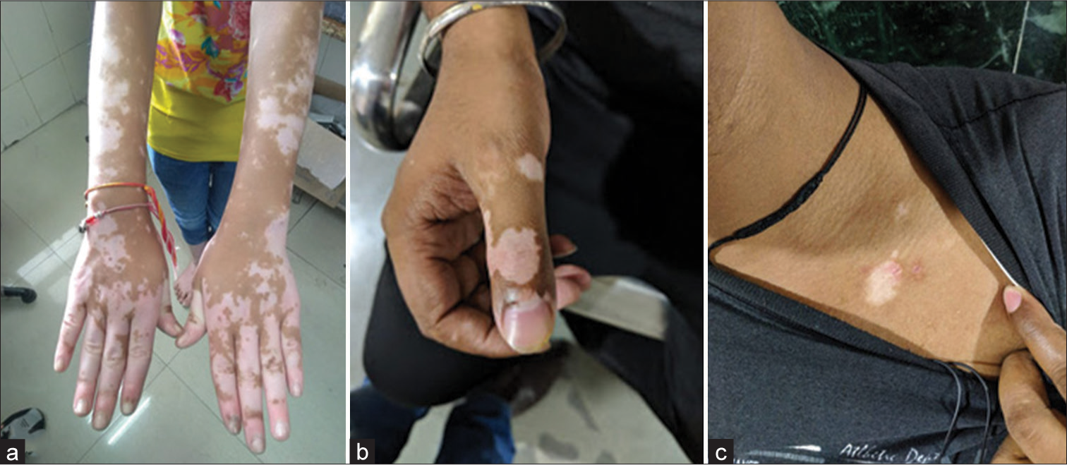 (a-c) Common sites of lesion upper extremity and chest.