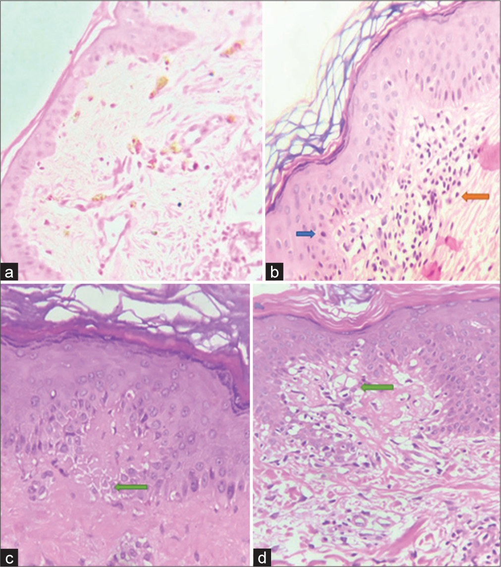 Histopathological parameters (a) Dermal melanophages, (b) Epidermal lymphocytes (blue solid arrow) and dermal lymphocytes (orange solid arrow), (c) Spongiosis (green solid arrow), and (d) Basal cell vacuolation (green solid arrow).