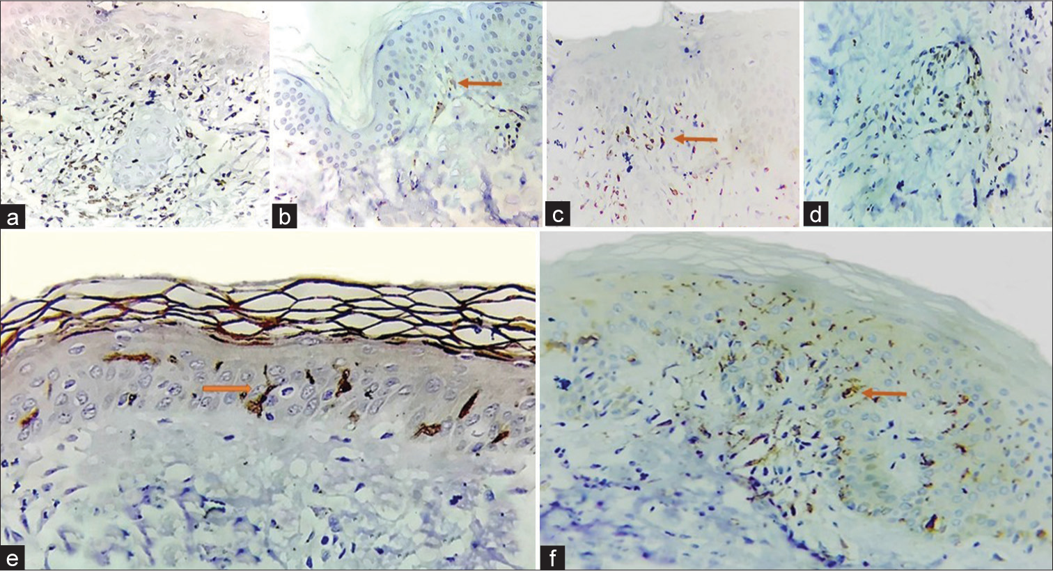 Distribution of inflammatory cells (a) T cells in stratum basale, (b) T cells in stratum basale (solid orange arrow), (c) T cells in the dermis (orange solid arrow) (d) Perivascular T cells, (e and f) Intra-epidermal Langerhans cells (solid orange arrows).