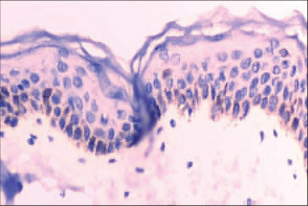 Melan-A immunohistochemistry on perilesional skin shows positivity in melanocytes.