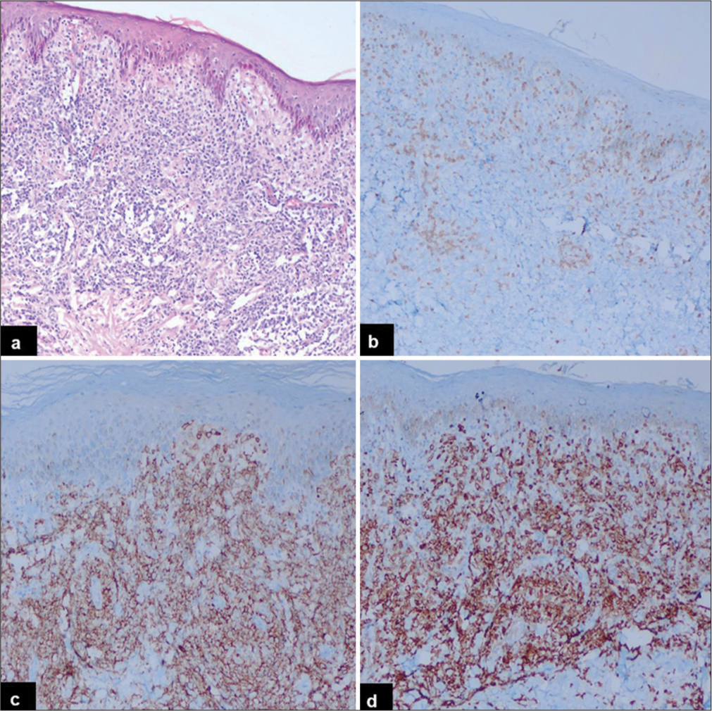 Immunohistochemical findings of primary extranodal-double-expressor phenotype of lymphoma (skin), activated B-cell phenotype (low power): (a) A diffuse sheet of atypical lymphoid cells seen in the dermis (Hematoxylin and eosin, ×20). (b) CD3 highlights reactive T lymphocytes (Diaminobenzidine, ×20). (c) CD20 stains atypical B-cells (Diaminobenzidine, ×20). (d) The tumor cells express BCL2 (Diaminobenzidine, ×20).