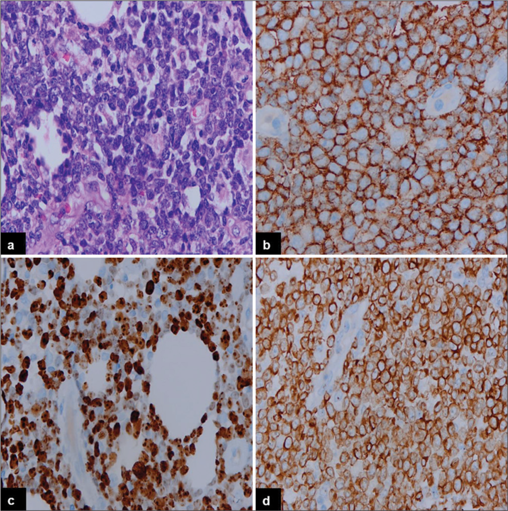 Immunohistochemical findings of primary extranodal-double-expressor phenotype of lymphoma (skin), activated B-cell phenotype (high power): (a) The tumor cells are large in size with non-cleaved nuclei (Hematoxylin and eosin, ×40). (b) The tumor cells show immunopositivity for CD20, (c) MYC, (d), and BCL2 (Diaminobenzidine, ×40).