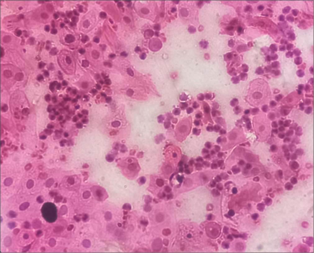 Predominantly Parabasal cells, hematoxylin, and eosin (H&E) stain, 40x.