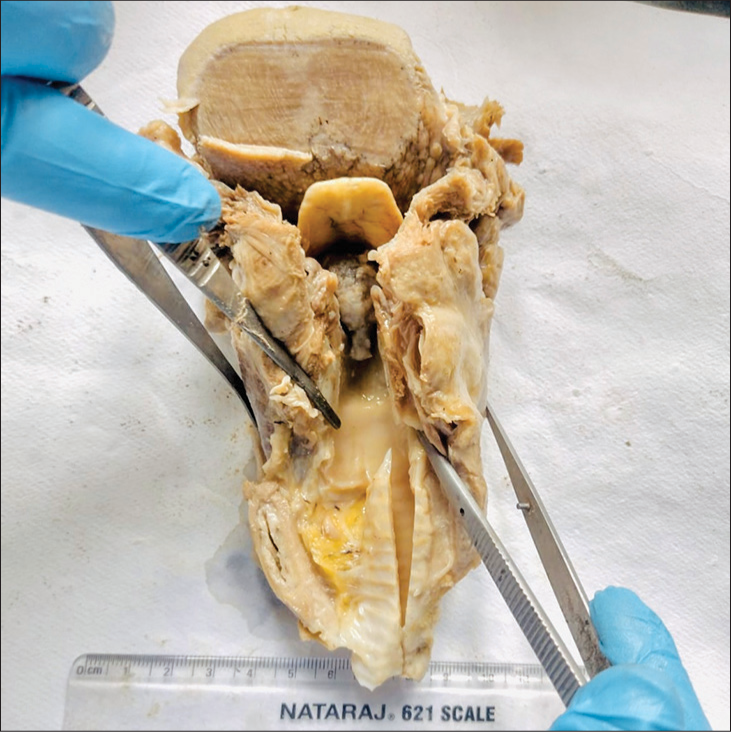 Gross image showing an a polypoidal pedunculated mass present in the midline of the glottic region (autopsy specimen).