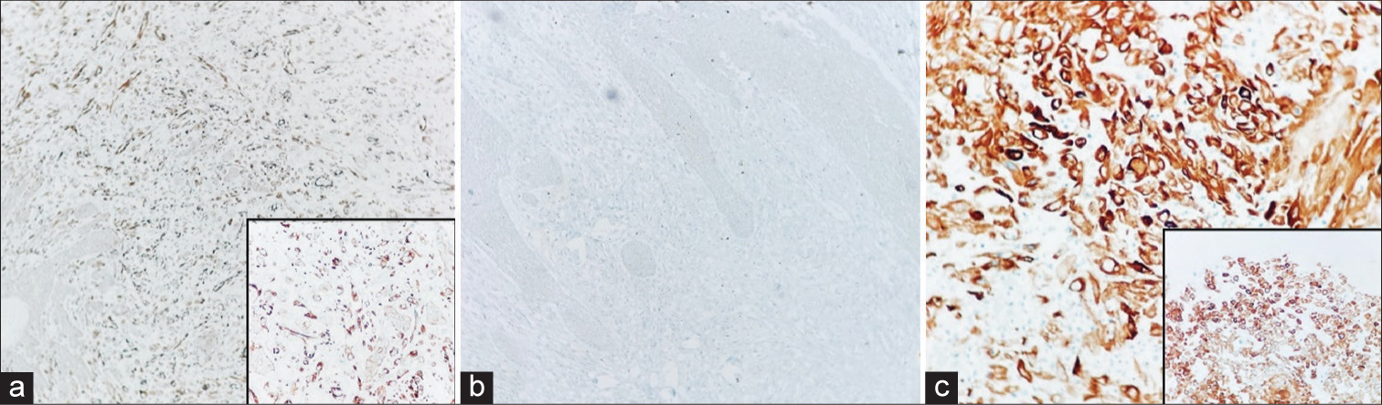 IHC- (a) CK5/6: Positive (×40) (Inset- high-power image [×200]), (b) Epithelial-cadherin: Negative (×40), (c) IHC: Vimentin positive (×100) (Inset- high-power image [×200]). IHC: Immunohistochemistry.