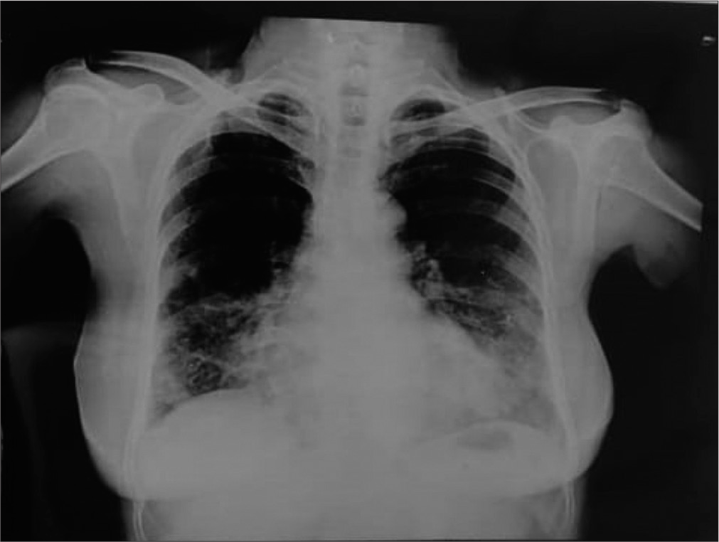 Chest X-ray showing cystic areas in the right middle zone, right lower zone, and left lower zone.