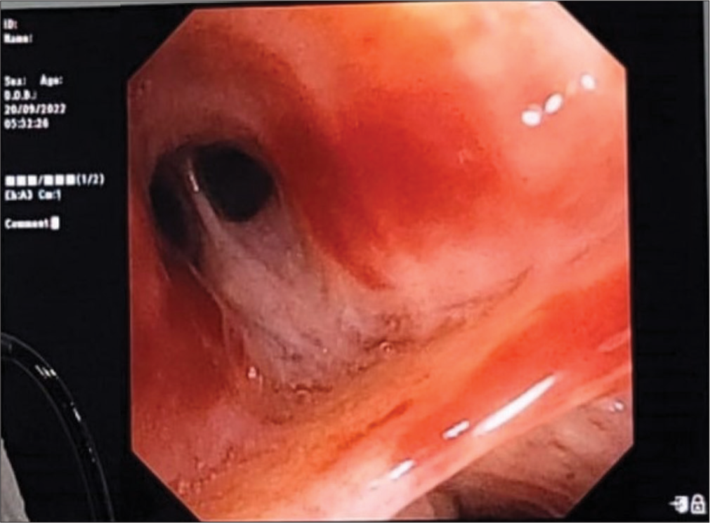 Bronchoscopy image showing thick mucopurulent secretion in the right middle lobe medial segment.