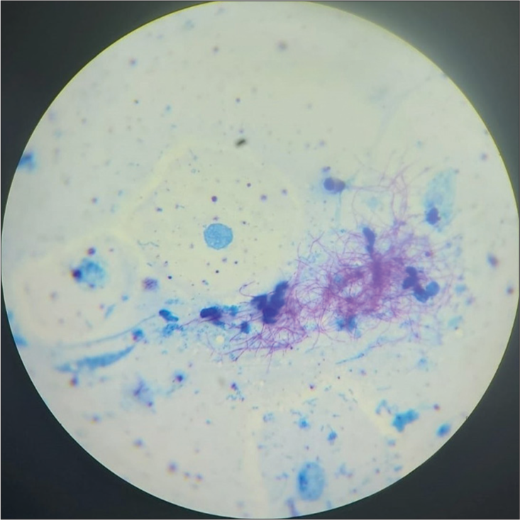 Modified Ziehl Neelsen staining showing acid-fast branching filamentous bacilli.