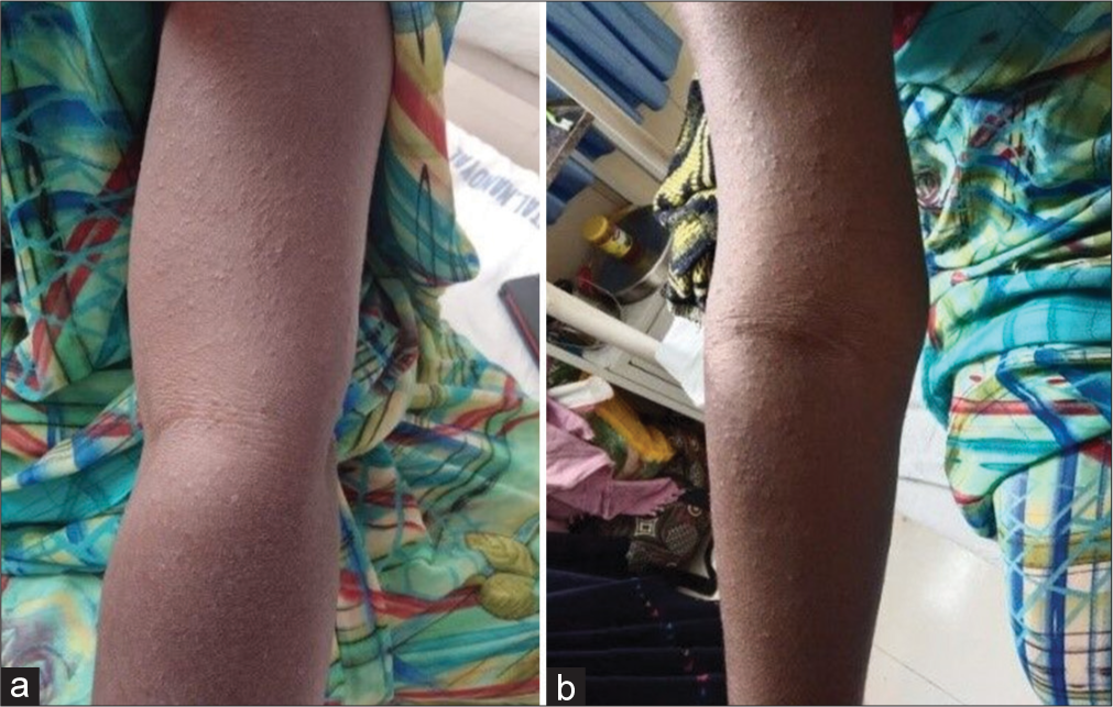 (a) Pyrazinamide induced rash (b) Rash view