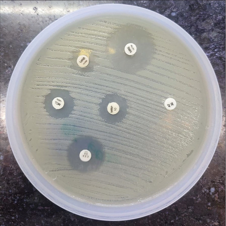 Synergy has been seen with Meropenem + Ethylenediaminetetraacetic acid disk on a combined disk test showing the production of metallobetalactamase.