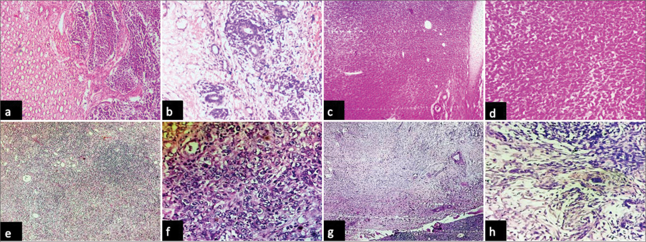 Photomicrographs: (a and b) Wilms tumor composed of blastemal, epithelial and mesenchymal component with focal anaplasia (hematoxylin and eosin, x4 and x40 objective lens respectively), (c and d) congenital mesoblastic nephroma composed of plump cells arranged in sheets with islands of hyaline cartilage (hematoxylin and eosin, x4 and x40 objective lens respectively), (e and f) urothelial carcinoma of the renal pelvis composed of pleomorphic cells arranged in sheets seen infiltrating renal parenchyma with prominent interstitial inflammation (hematoxylin and eosin, x4 and x40 objective lens respectively), and (g and h) showing structure of kidney with leiomyosarcoma composed of pleomorphic spindle shaped cells arranged in fascicles showing focal hyalinization (hematoxylin and eosin, x4 and x40 objective lens respectively).