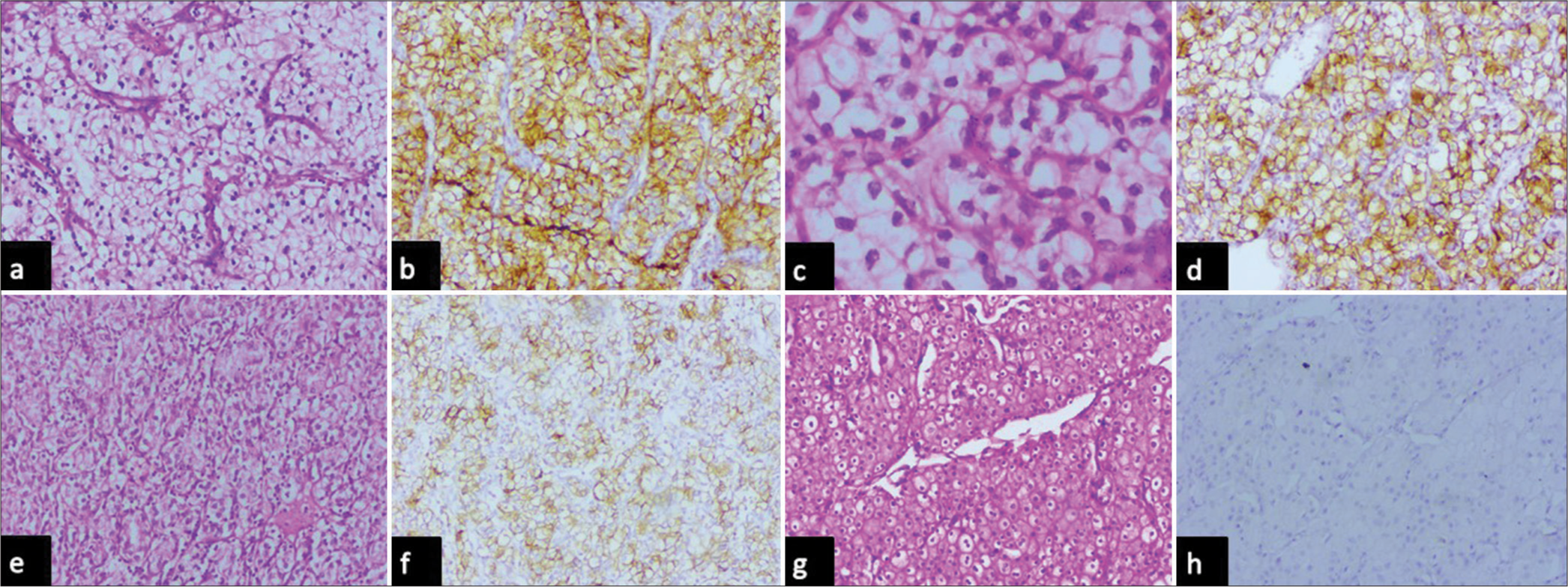 Photomicrographs of (a and b) clear cell renal cell carcinoma with nuclear grade 1 showing box like intense membrane positivity (high) for carbonic anhydrase IX (hematoxylin and eosin, x10 objective lens and diaminobenzidine, x10 objective lens respectively), (c and d) clear cell renal cell carcinoma with nuclear grade 2 membrane positivity in less than 85% of tumor cells for carbonic anhydrase IX (hematoxylin and eosin, x40 objective lens and diaminobenzidine, x10 objective lens respectively), (e and f) clear cell renal cell carcinoma with nuclear grade 3 showing less than 85% of tumor cells for carbonic anhydrase IX (hematoxylin and eosin, x10 objective lens and diaminobenzidine, x10 objective lens respectively), and (g and h) chromophobe cell renal cell carcinoma showing no expression of Carbonic anhydrase IX (hematoxylin and eosin, x10 objective lens and diaminobenzidine, x10 objective lens respectively).