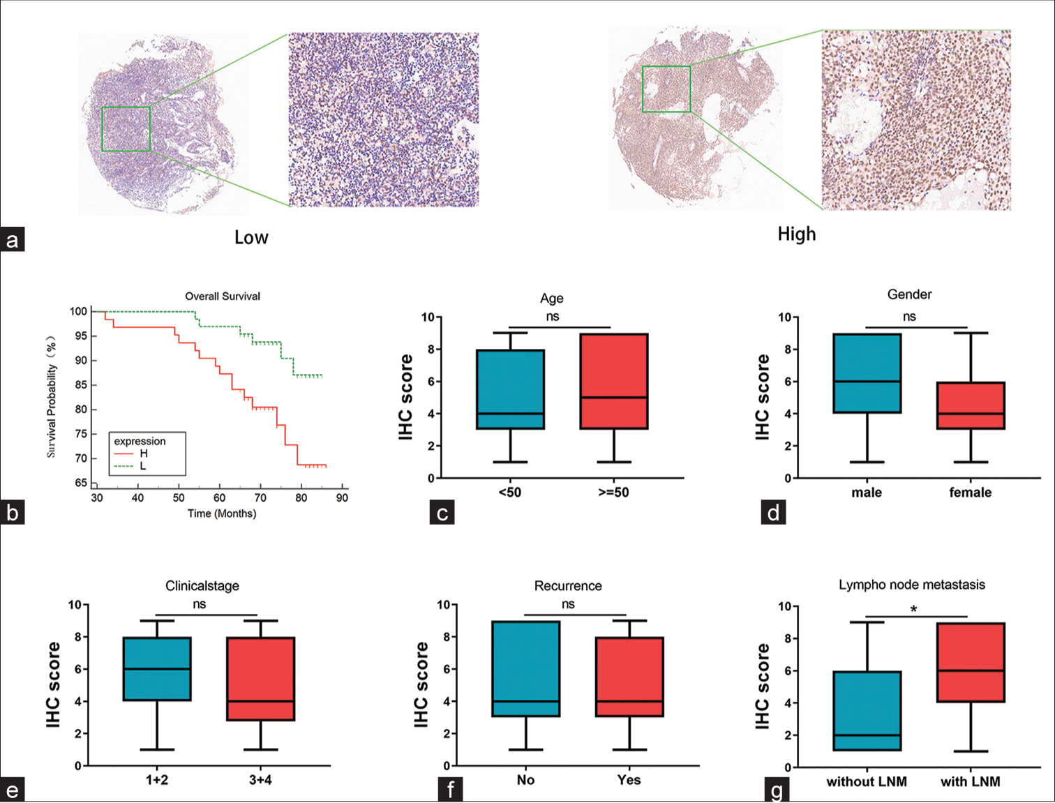 Nasopharyngeal carcinoma (NPC) microarray-based bromodomain-containing 4 (BRD4) immunohistochemistry staining results. (a) Evaluation of BRD4 protein expression in NPC samples revealed staining predominantly in cancer cell cytoplasm. (b) Survival analysis results demonstrated that patients with high BRD4 expression in NPC had a shorter overall survival time compared to those with low expression (P < 0.05). (c-f) There was no significant correlation between BRD4 expression and age, gender, clinical stage, and recurrence (P > 0.05). (g) Significant correlation was observed between BRD4 and lymph node metastasis (P < 0.05). ns: Not statistically significant, IHC: Immunohistochemistry, LNM: Lymph node metastasis. *P < 0.05.