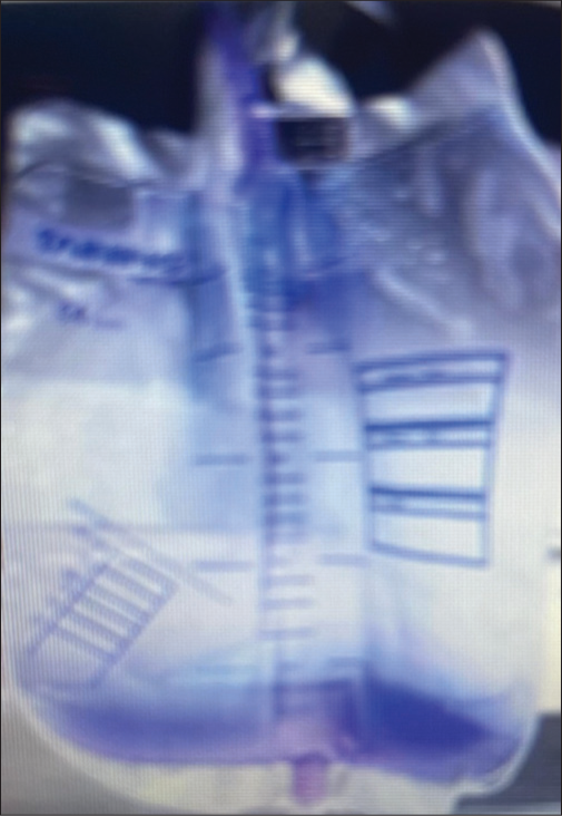 A 72-year-old female patient having Paraparesis and on urine catheter for 4 weeks. She also had a history of chronic constipation and developed purple-colored urine.