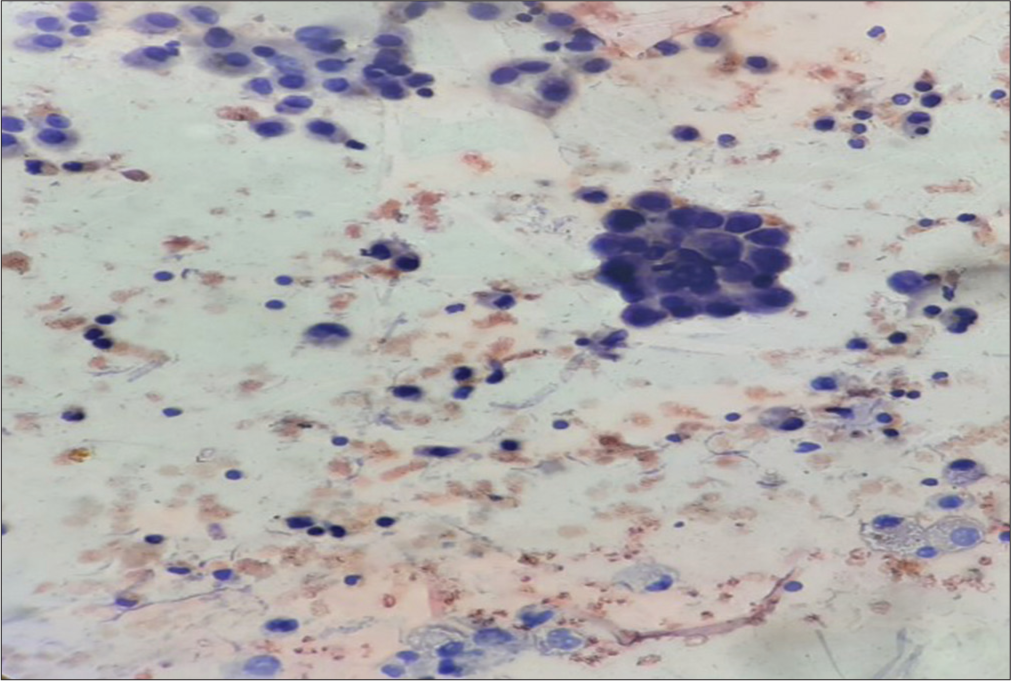 Numerous small, atypical cells in clusters along with cyst macrophages in the cytosmears of fluid aspirated from the thyroglossal cyst (Papanicolaou stain, ×400).