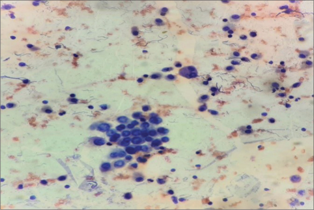 Atypical cells having ground glass nuclei along with cyst macrophages in the cytosmears of fluid aspirated from the thyroglossal cyst (Papanicolaou stain, ×400).