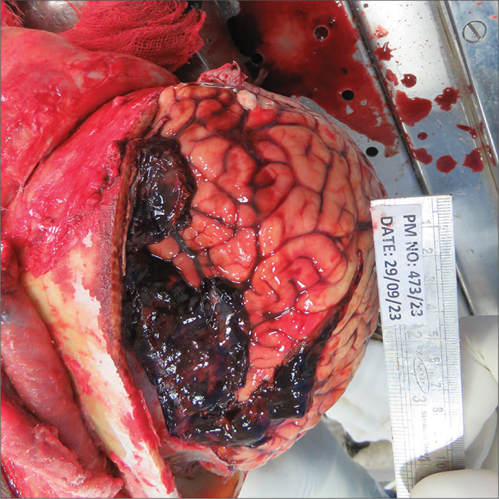 Subdural and subarachnoid hemorrhage.